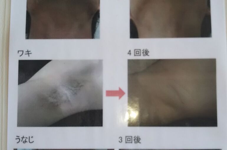 太い毛も細い産毛もケアOK❣